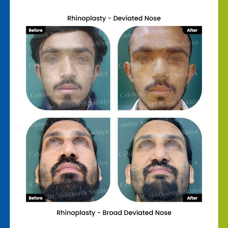 rhinoplasty Testimonia17