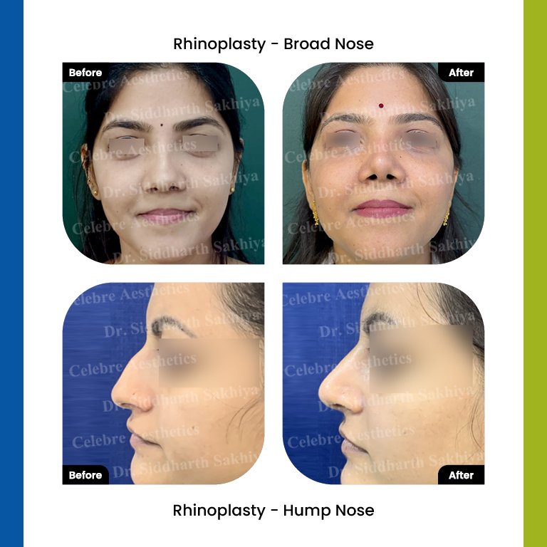 rhinoplasty Testimonia16