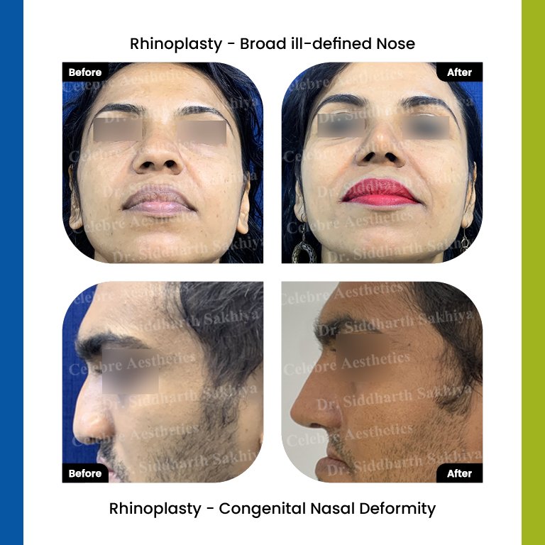 rhinoplasty Testimonia15