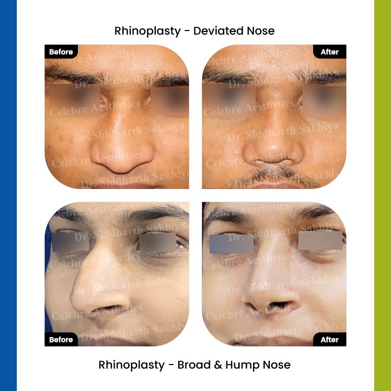 rhinoplasty Testimonia14