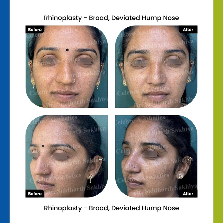 rhinoplasty Testimonia13
