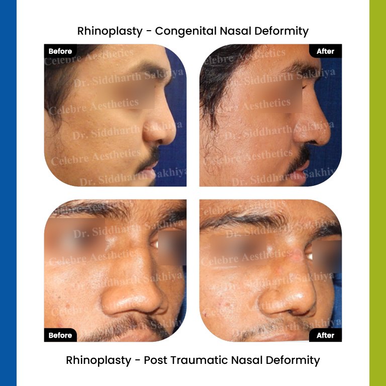 rhinoplasty Testimonia12