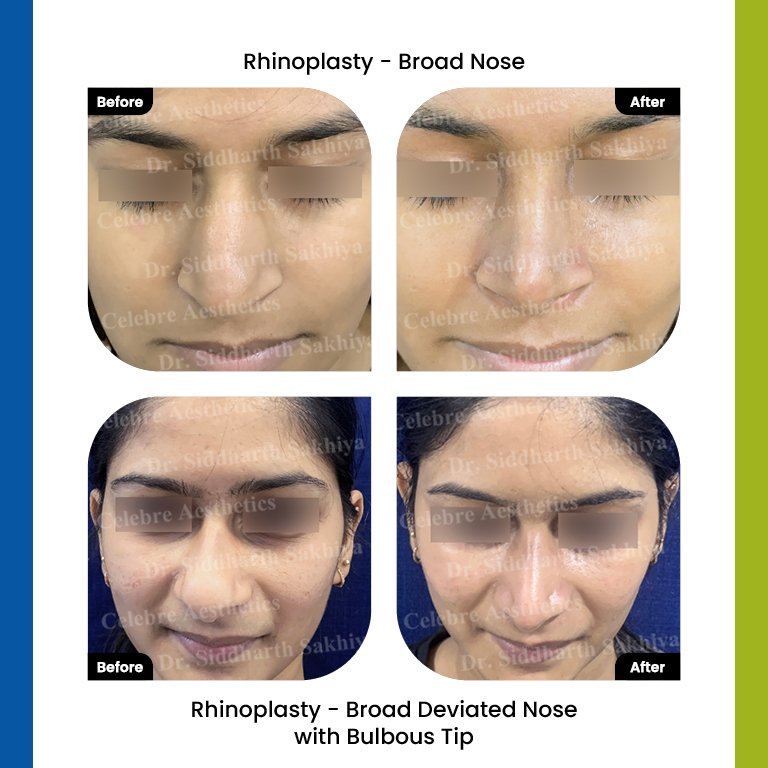 rhinoplasty Testimonia11