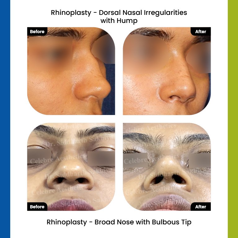 rhinoplasty Testimonia10
