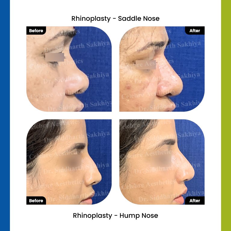 rhinoplasty Testimonia9