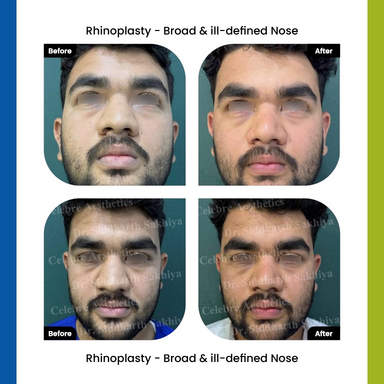 rhinoplasty Testimonia8