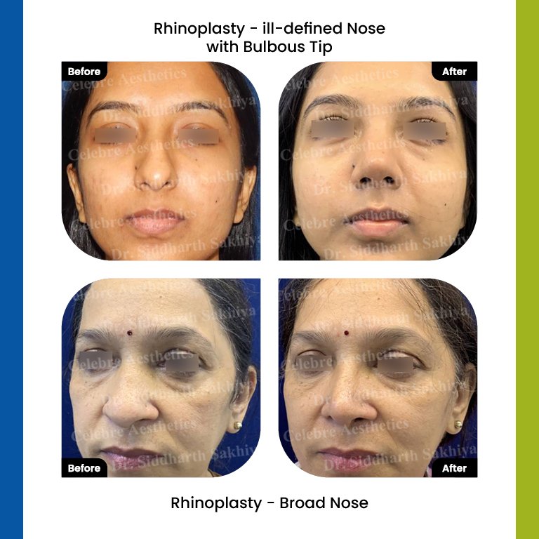 rhinoplasty Testimonia6