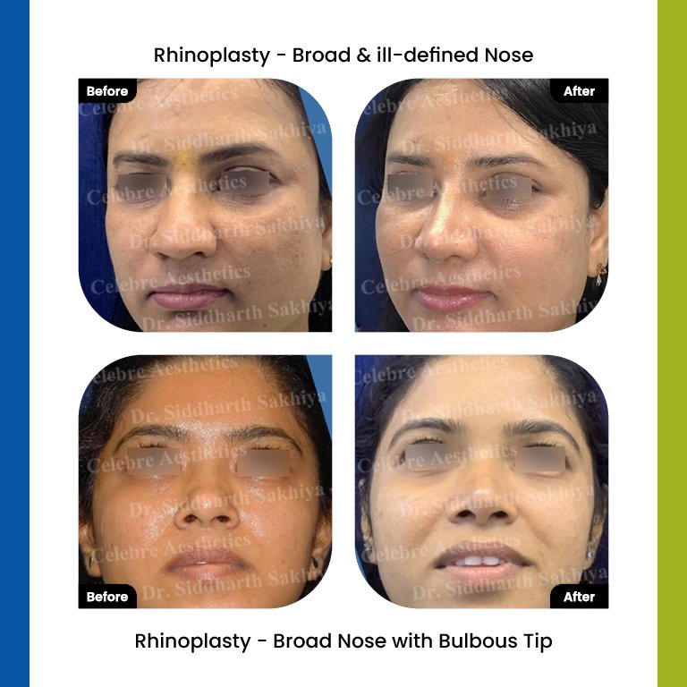 rhinoplasty Testimonia5