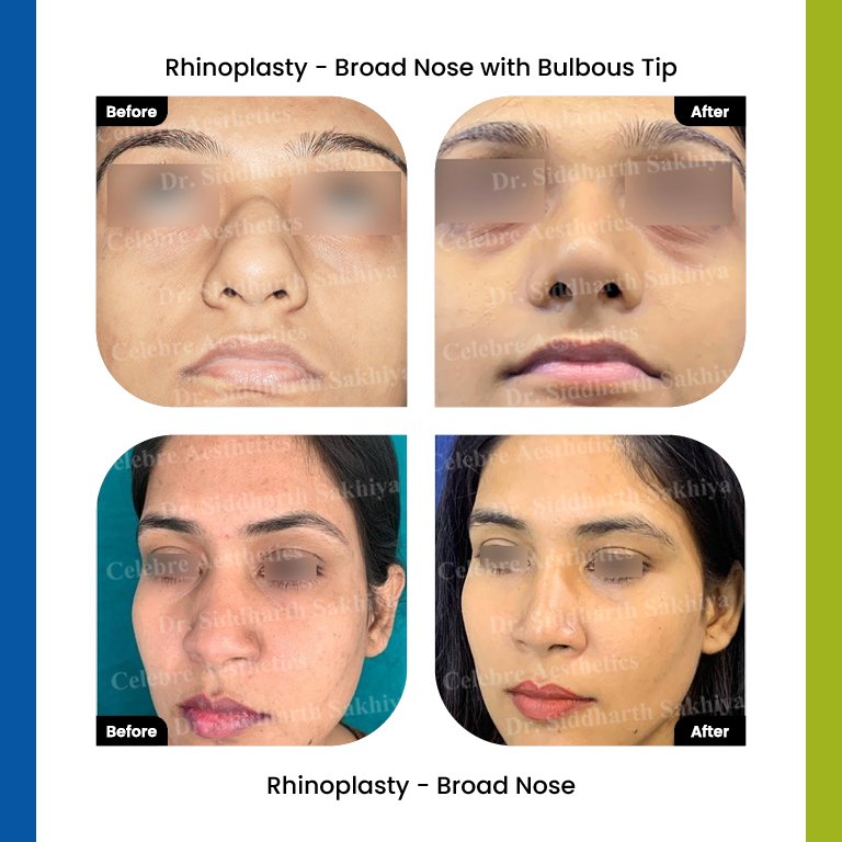 rhinoplasty Testimonia4
