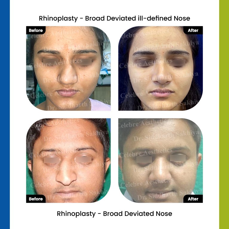 rhinoplasty Testimonia3