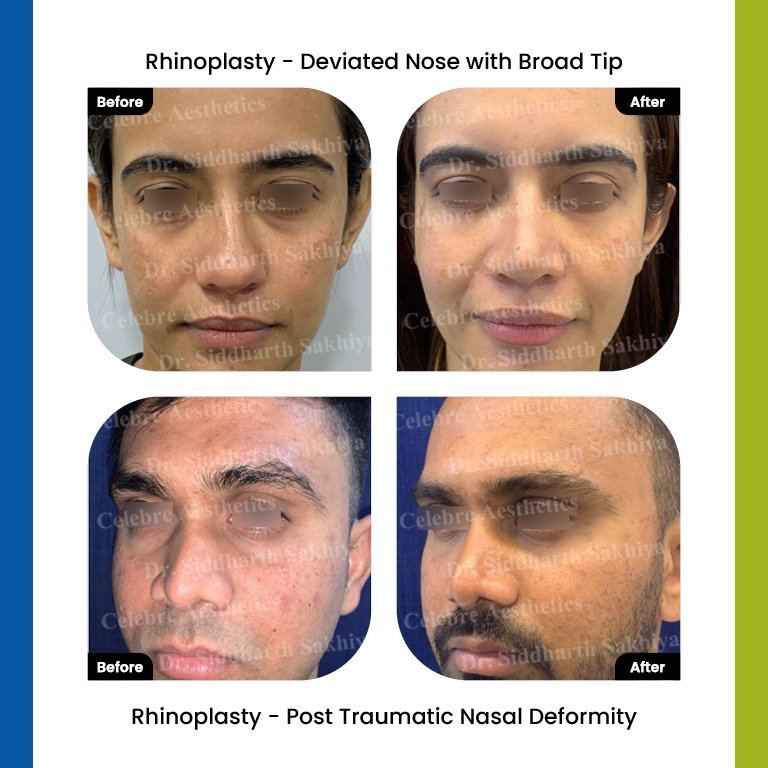 rhinoplasty Testimonia2
