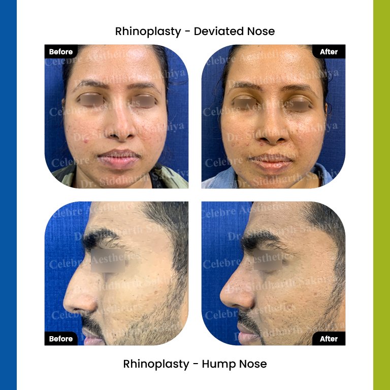 rhinoplasty Testimonia1