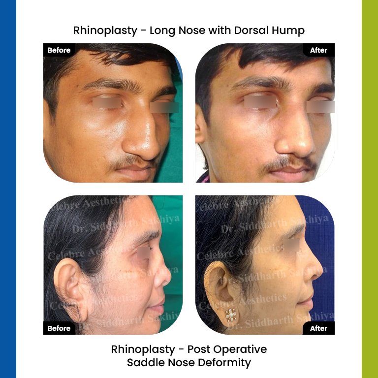 rhinoplasty Testimonia
