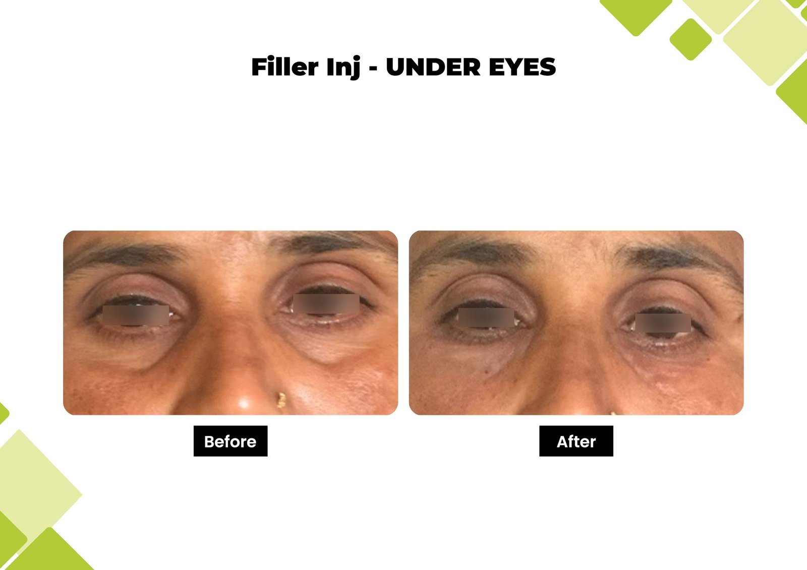 filler1